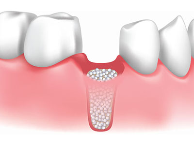 dental bone grafting treatment