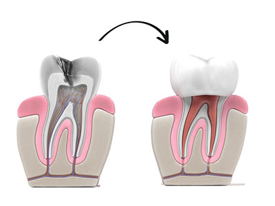 root canal treatment drbk clinic reading