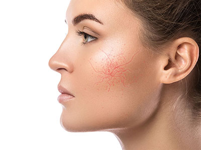 facial thread veins and rosacea laser skin treatment drbk clinic