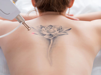 laser tattoo removal drbk clinic
