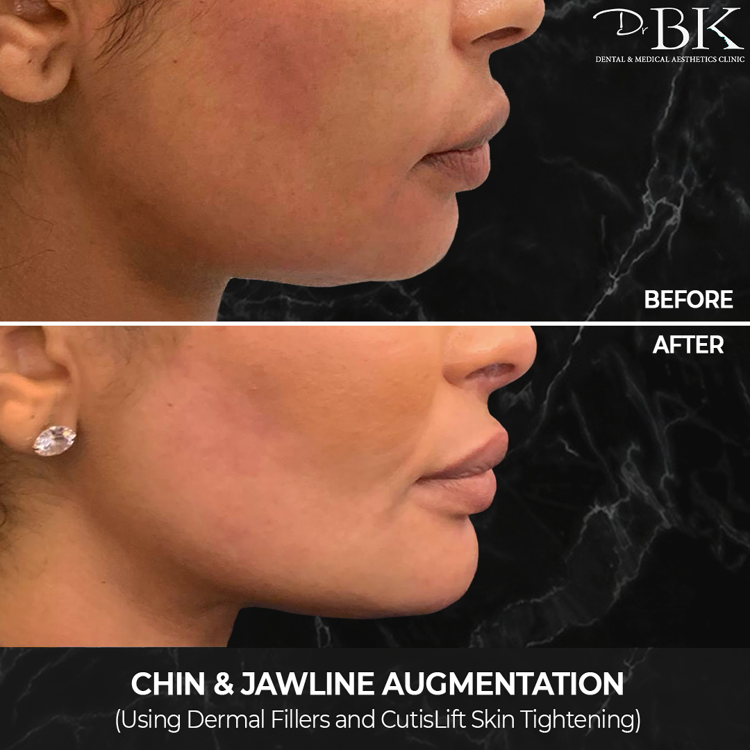Chin & Jawline Augmentation (using dermal fillers and CutisLift) at DrBK