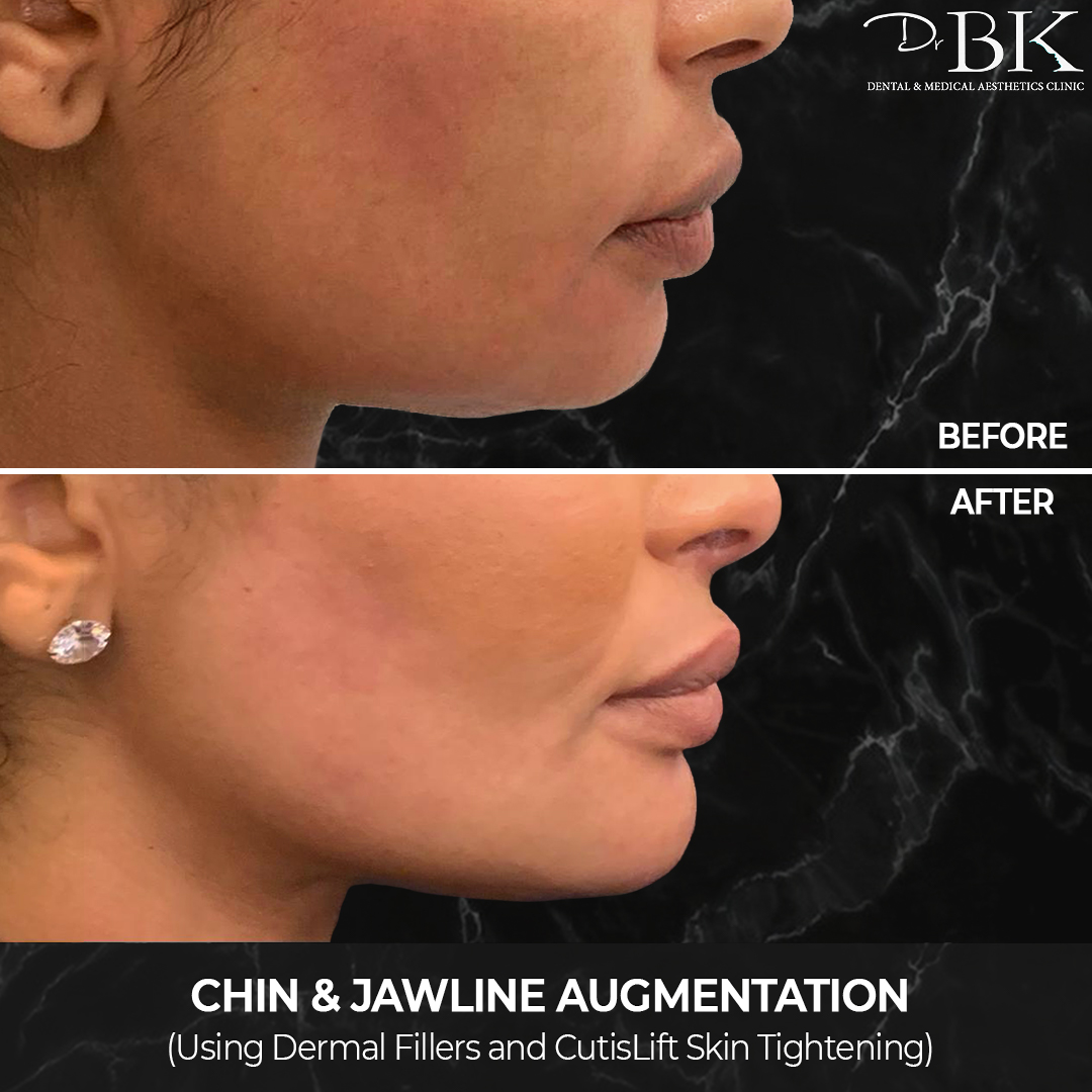 Chin & Jawline Augmentation (using dermal fillers and CutisLift) at DrBK Chin & Jawline Augmentation (using dermal fillers and CutisLift) at DrBK