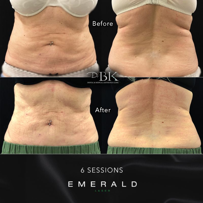 Emerald Fat Loss Laser at DrBK - Before & Afters Emerald Fat Loss Laser at DrBK - Before & Afters