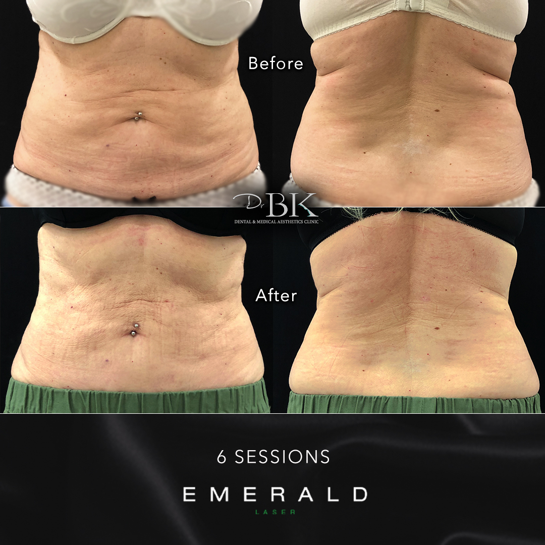 Emerald Fat Loss Laser at DrBK - Before & Afters Emerald Fat Loss Laser at DrBK - Before & Afters