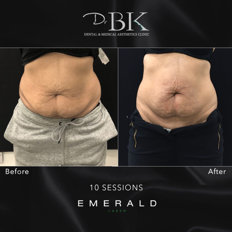 Emerald Fat Loss Laser at DrBK - Before & Afters Emerald Fat Loss Laser at DrBK - Before & Afters