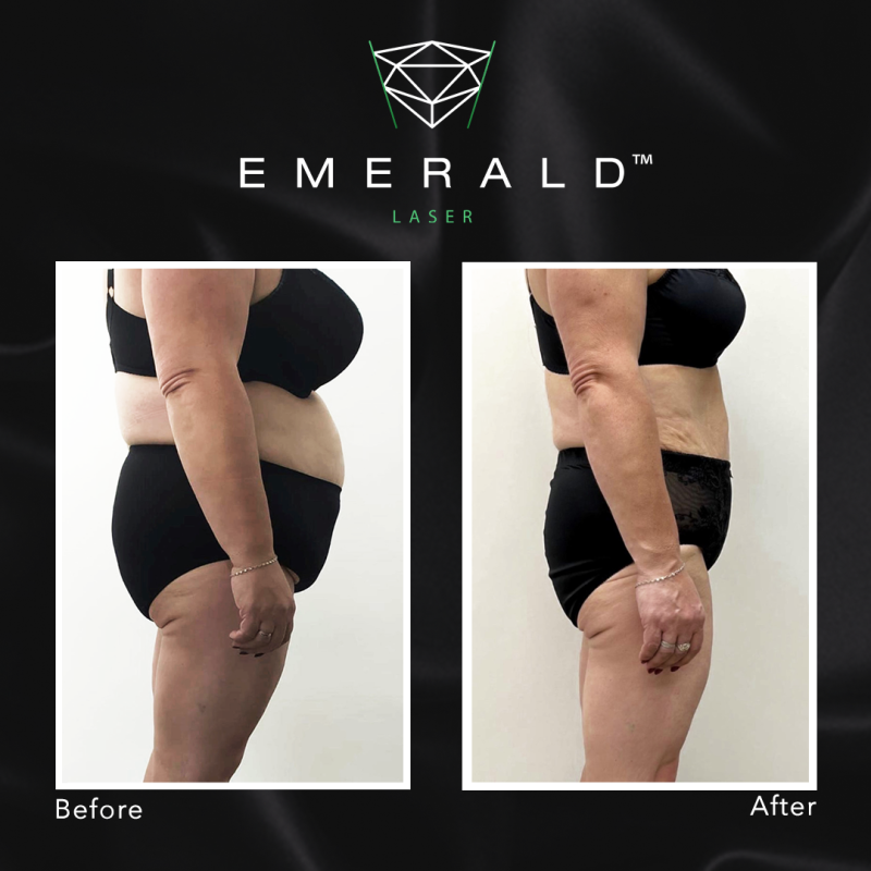 Emerald Fat Loss Laser at DrBK - Before & Afters Emerald Fat Loss Laser at DrBK - Before & Afters