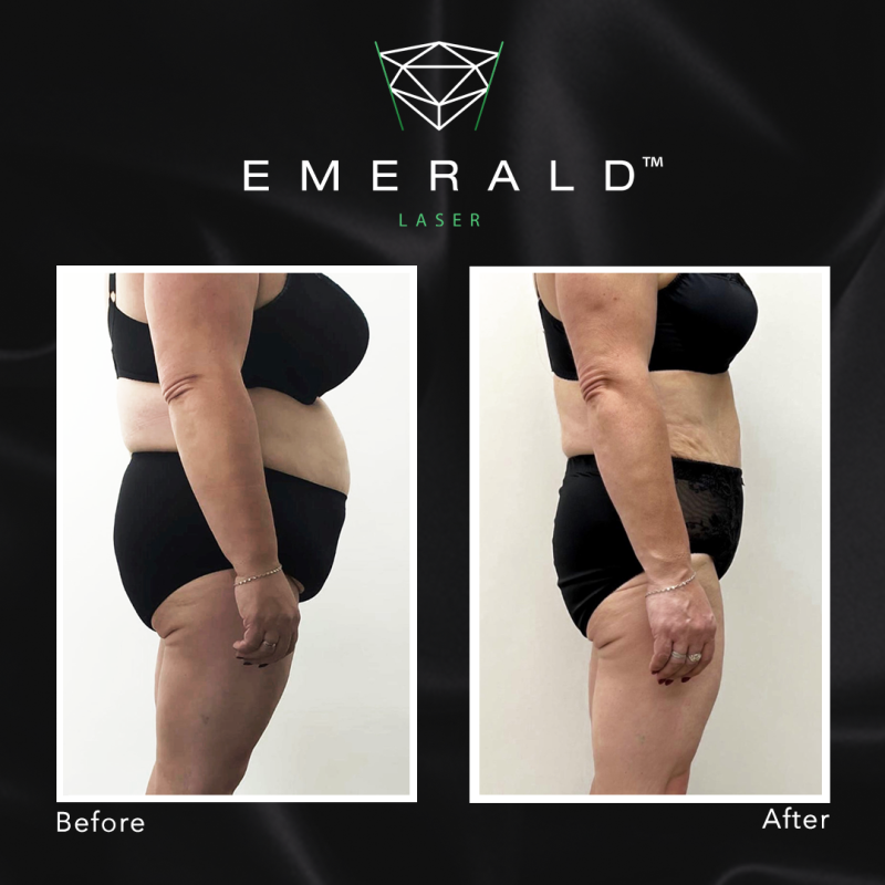 Emerald Fat Loss Laser - Before and After