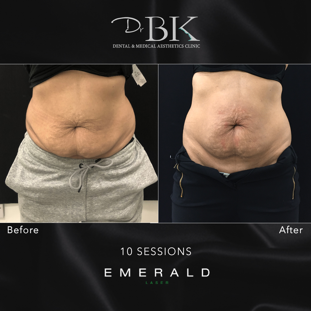 Emerald Fat Loss Laser at DrBK - Before & Afters Emerald Fat Loss Laser at DrBK - Before & Afters