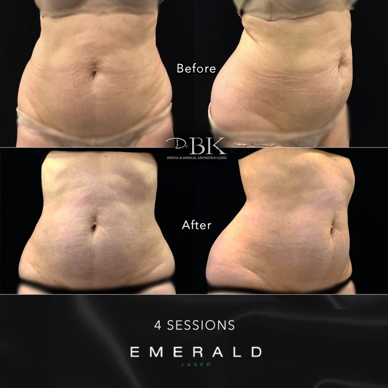 Emerald Fat Loss Laser at DrBK - Before & Afters Emerald Fat Loss Laser at DrBK - Before & Afters