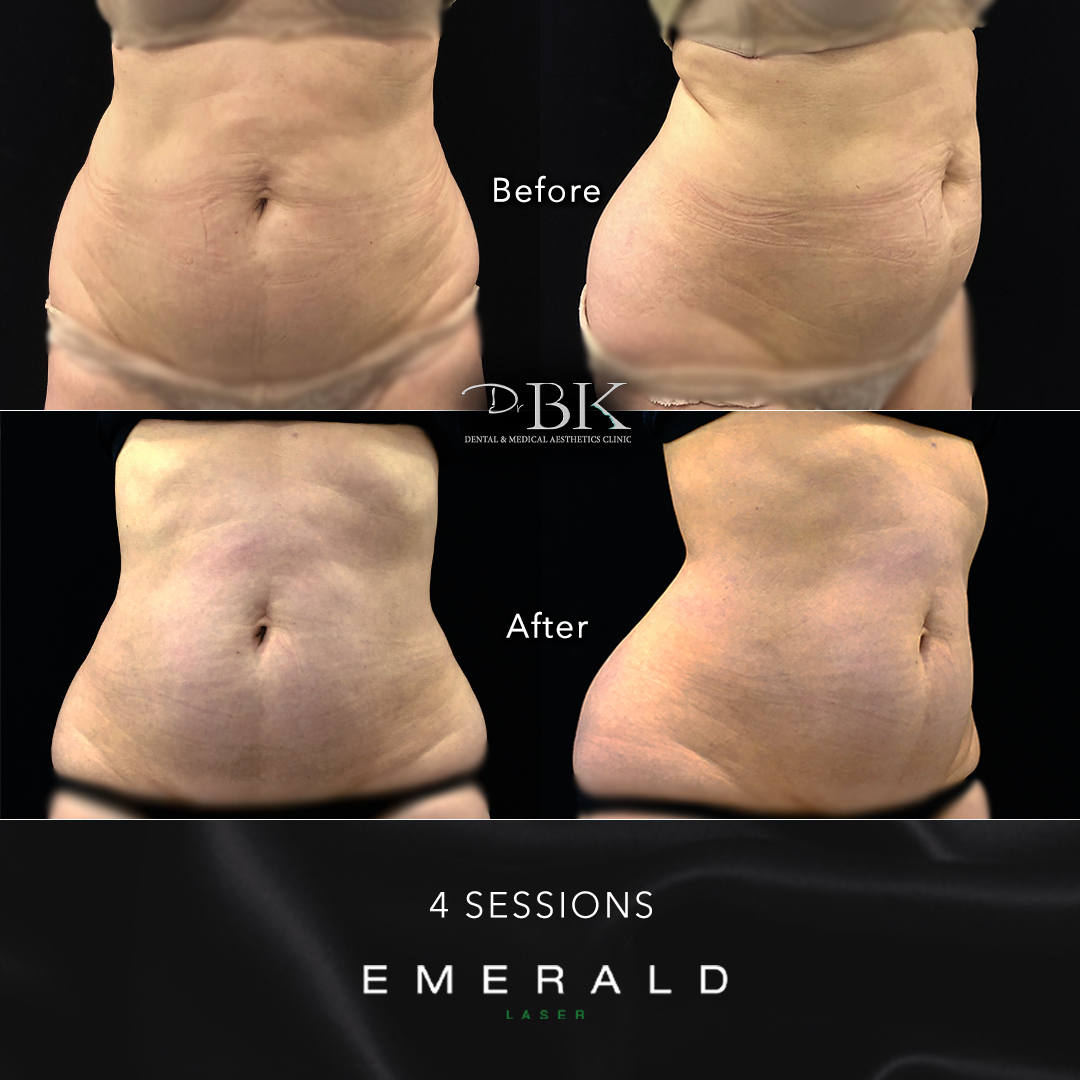 Emerald Fat Loss Laser at DrBK - Before & Afters Emerald Fat Loss Laser at DrBK - Before & Afters