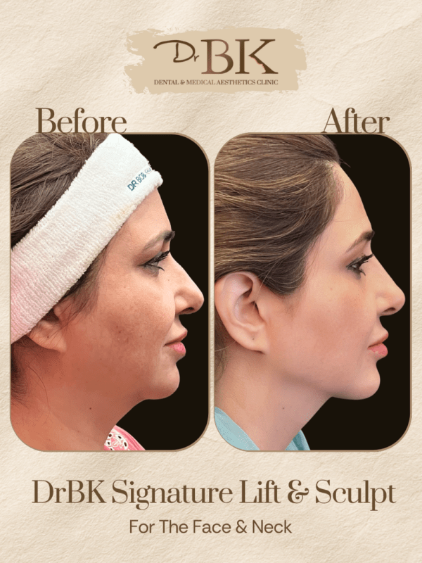 10 Before and after image of DrBK Signature Non-Surgical Facelift with Threads