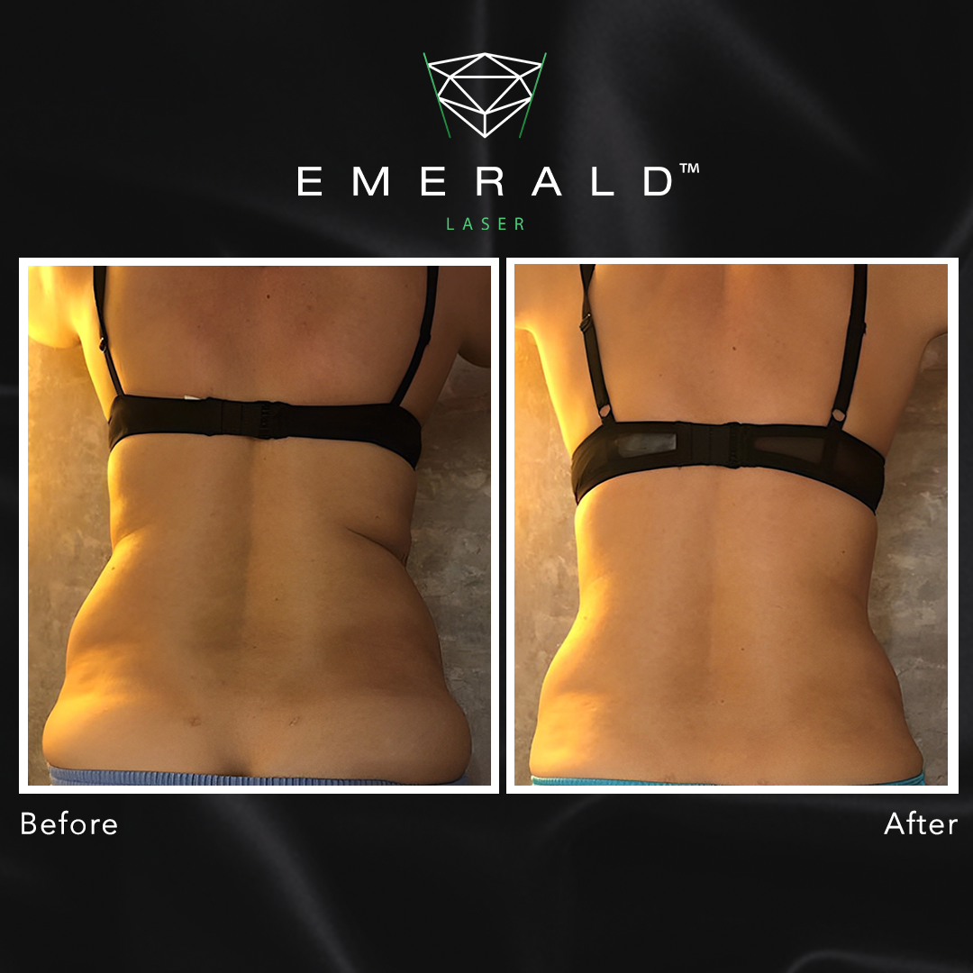 Emerald Fat Loss Laser - Before and After Emerald Fat Loss Laser - Before and After