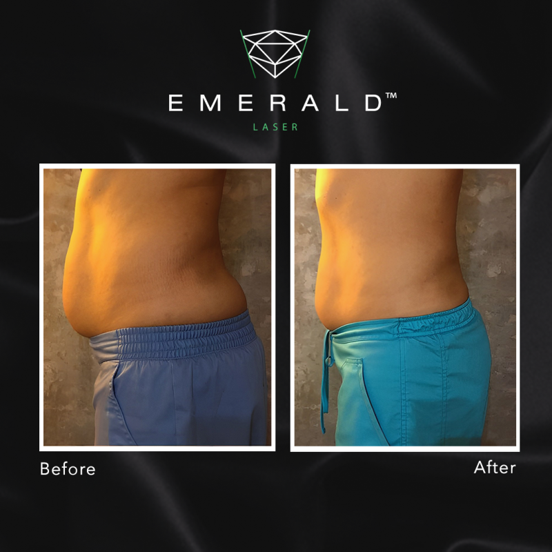 Emerald Fat Loss Laser - Before and After Emerald Fat Loss Laser - Before and After