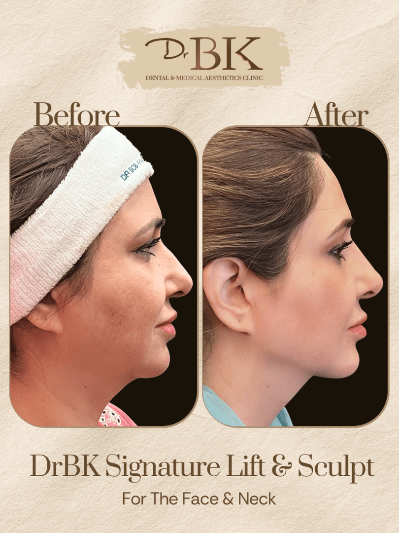 10 Before and after image of DrBK Signature Non-Surgical Facelift with Threads