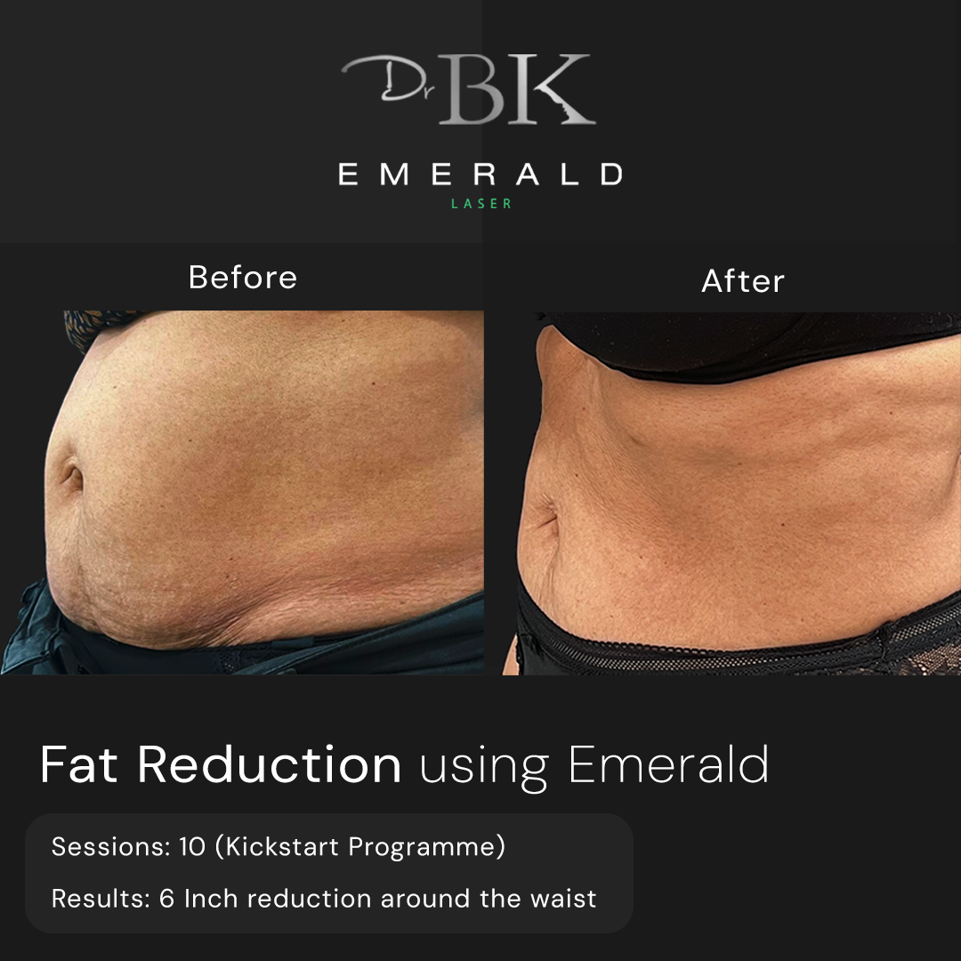 Emerald Fat Loss Laser at DrBK - Before & Afters Emerald Fat Loss Laser at DrBK - Before & Afters