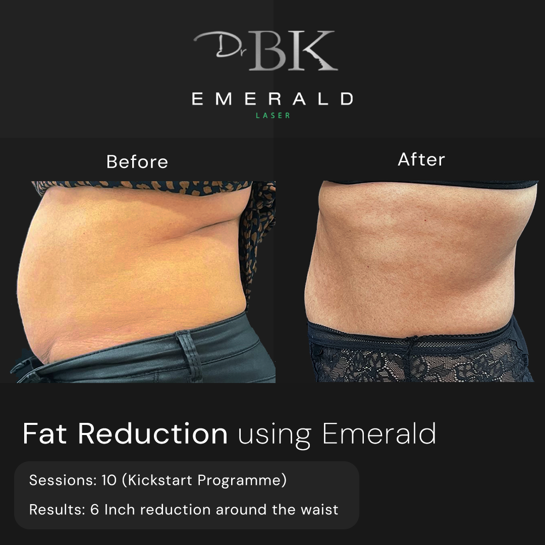 Emerald Fat Loss Laser at DrBK - Before & Afters Emerald Fat Loss Laser at DrBK - Before & Afters