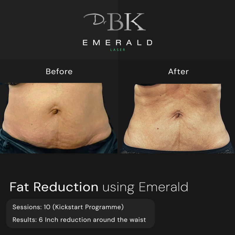 Emerald Fat Loss Laser at DrBK - Before & Afters Emerald Fat Loss Laser at DrBK - Before & Afters