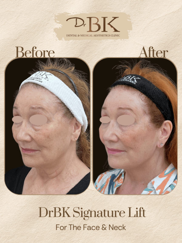 11 Before and after image of DrBK Signature Non-Surgical Facelift with Threads