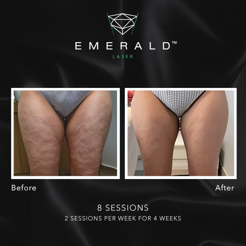 Emerald Fat Loss Laser - Before and After