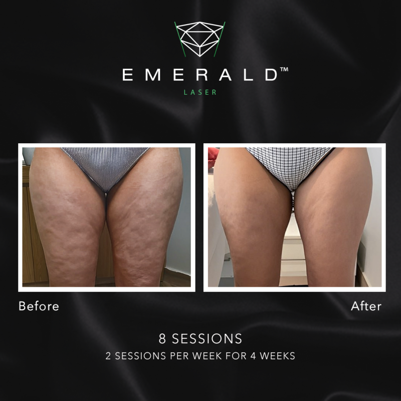 Emerald Fat Loss Laser - Before and After Emerald Fat Loss Laser - Before and After
