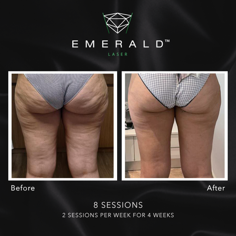 Emerald Fat Loss Laser - Before and After Emerald Fat Loss Laser - Before and After