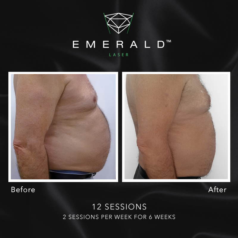 Emerald Fat Loss Laser - Before and After Emerald Fat Loss Laser - Before and After