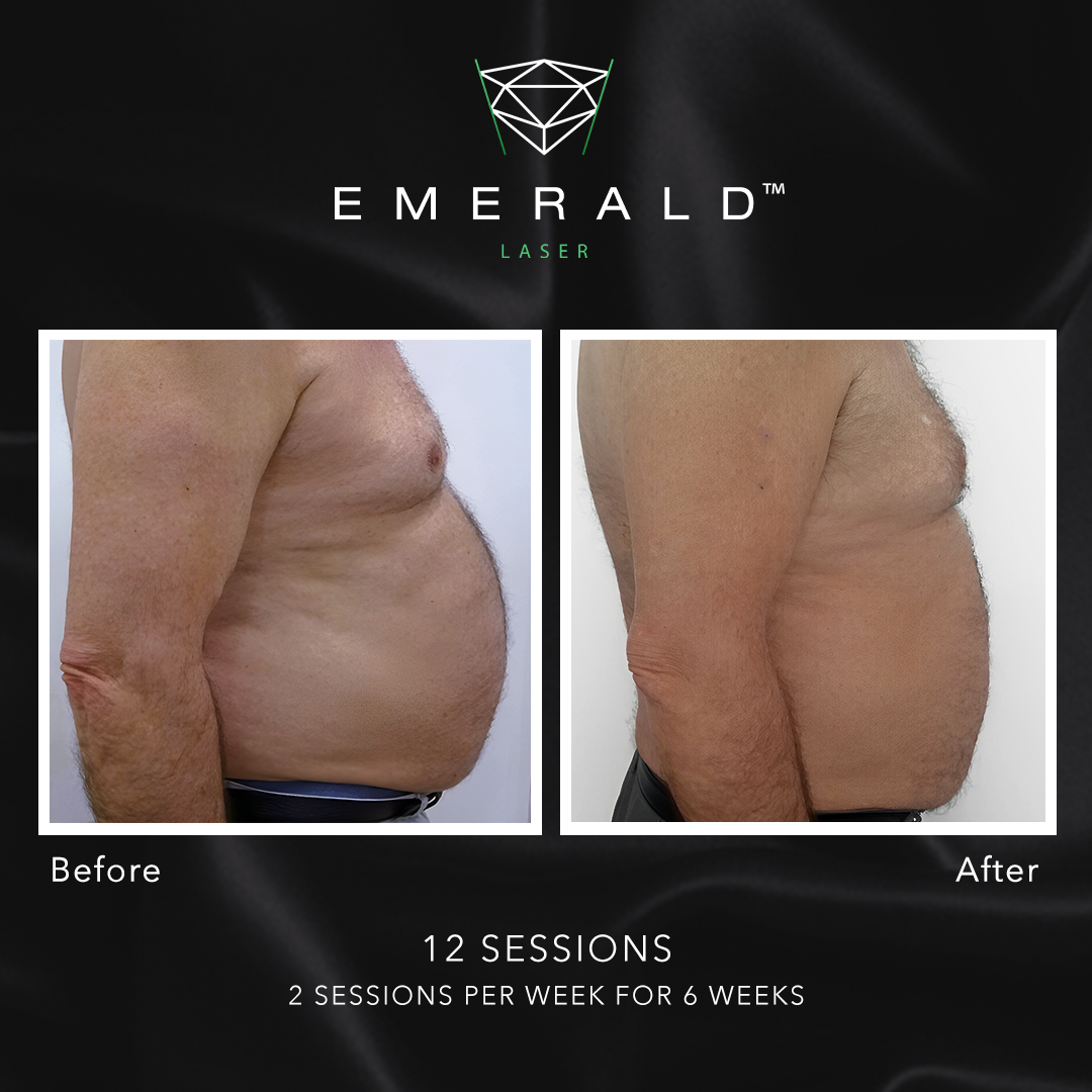 Emerald Fat Loss Laser - Before and After