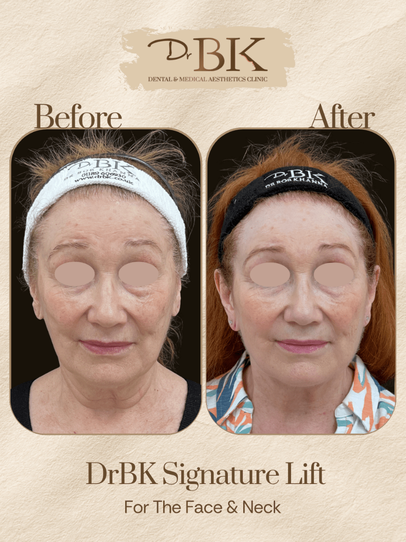12 Before and after image of DrBK Signature Non-Surgical Facelift with Threads