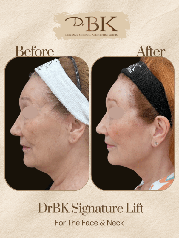 13 Before and after image of DrBK Signature Non-Surgical Facelift with Threads