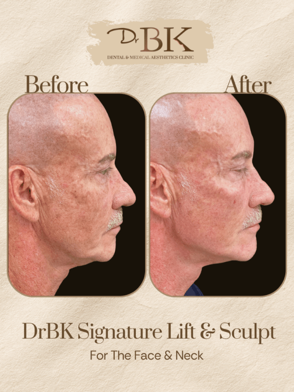 14 Before and after image of DrBK Signature Non-Surgical Facelift with Threads
