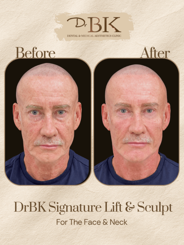 15 Before and after image of DrBK Signature Non-Surgical Facelift with Threads