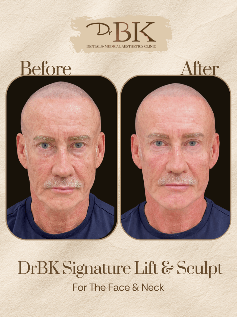 15 Before and after image of DrBK Signature Non-Surgical Facelift with Threads