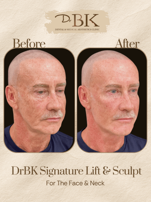 16 Before and after image of DrBK Signature Non-Surgical Facelift with Threads