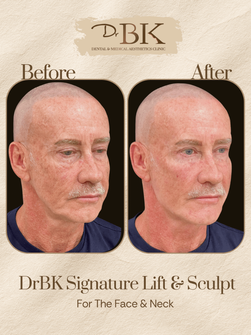 16 Before and after image of DrBK Signature Non-Surgical Facelift with Threads