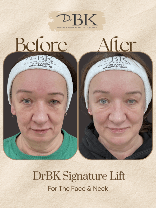 17 Before and after image of DrBK Signature Non-Surgical Facelift with Threads