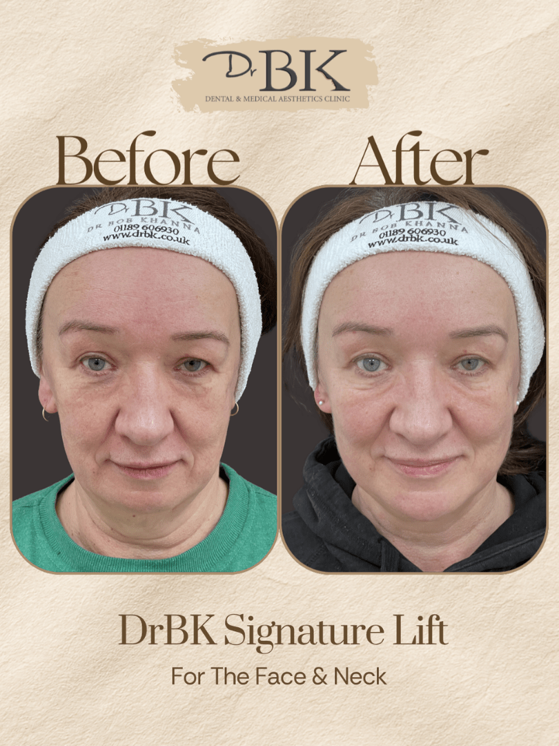 17 Before and after image of DrBK Signature Non-Surgical Facelift with Threads