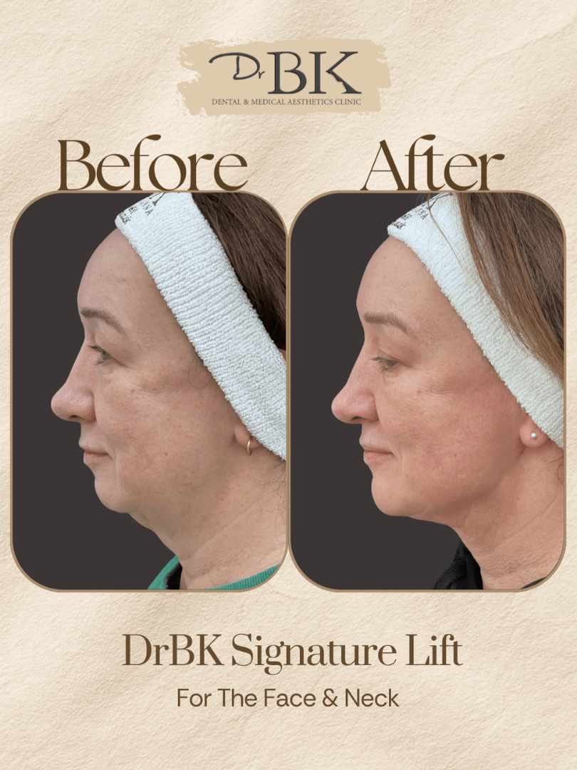 18 Before and after image of DrBK Signature Non-Surgical Facelift with Threads