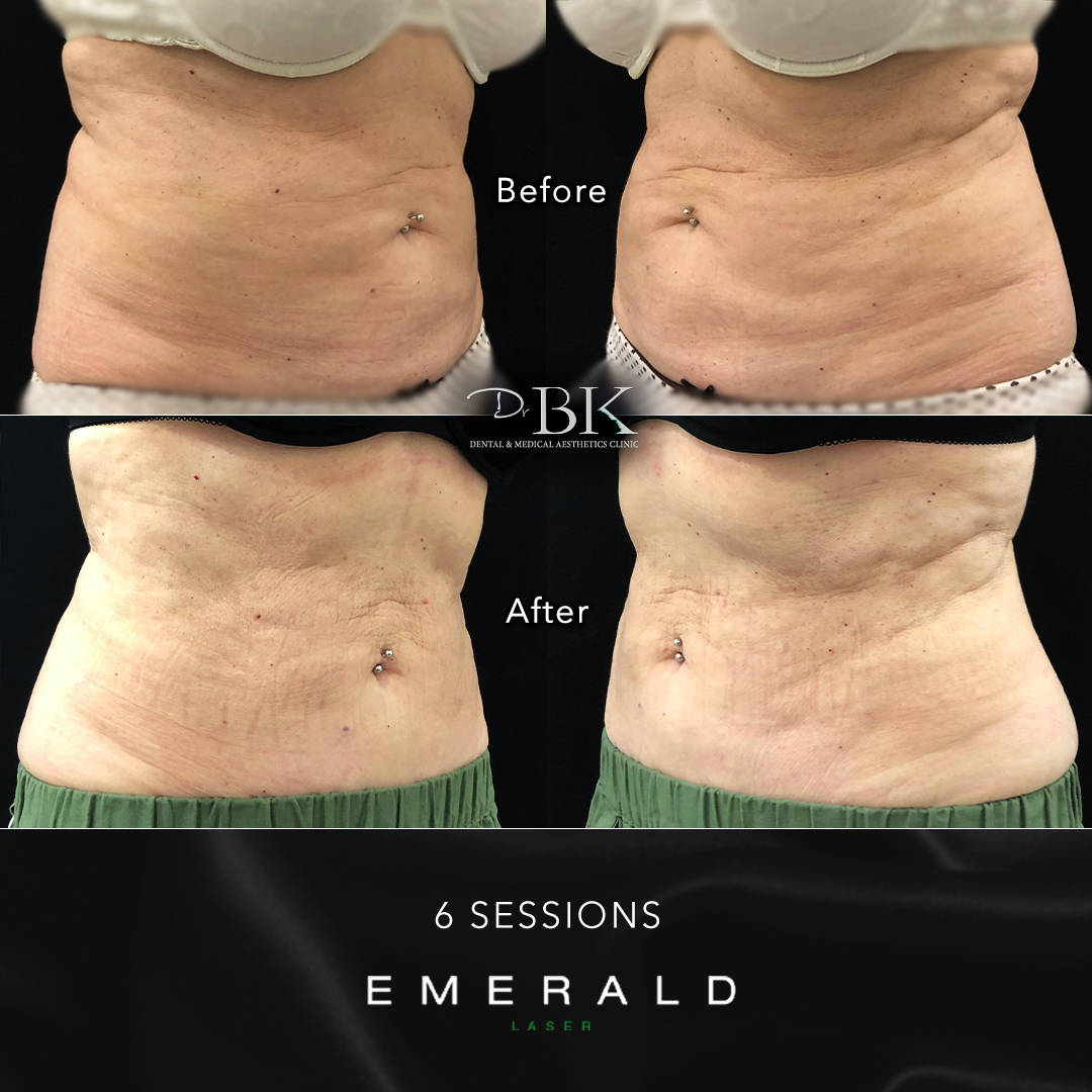 Emerald Fat Loss Laser at DrBK - Before & Afters Emerald Fat Loss Laser at DrBK - Before & Afters