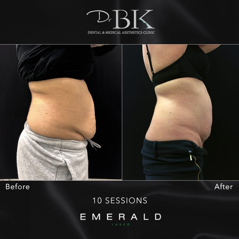 Emerald Fat Loss Laser at DrBK - Before & Afters Emerald Fat Loss Laser at DrBK - Before & Afters