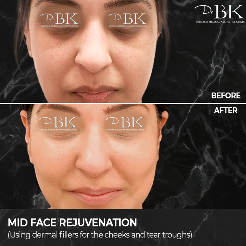 Before & After Tear Trough & Cheek Sculpting Before & After Tear Trough & Cheek Sculpting