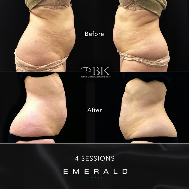 Emerald Fat Loss Laser at DrBK - Before & Afters Emerald Fat Loss Laser at DrBK - Before & Afters
