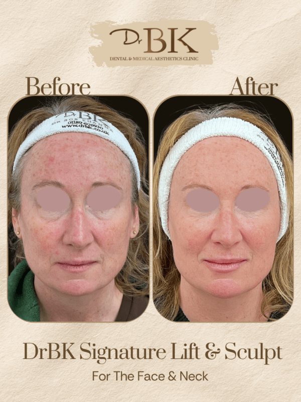 20 Before and after image of DrBK Signature Non-Surgical Facelift with Threads
