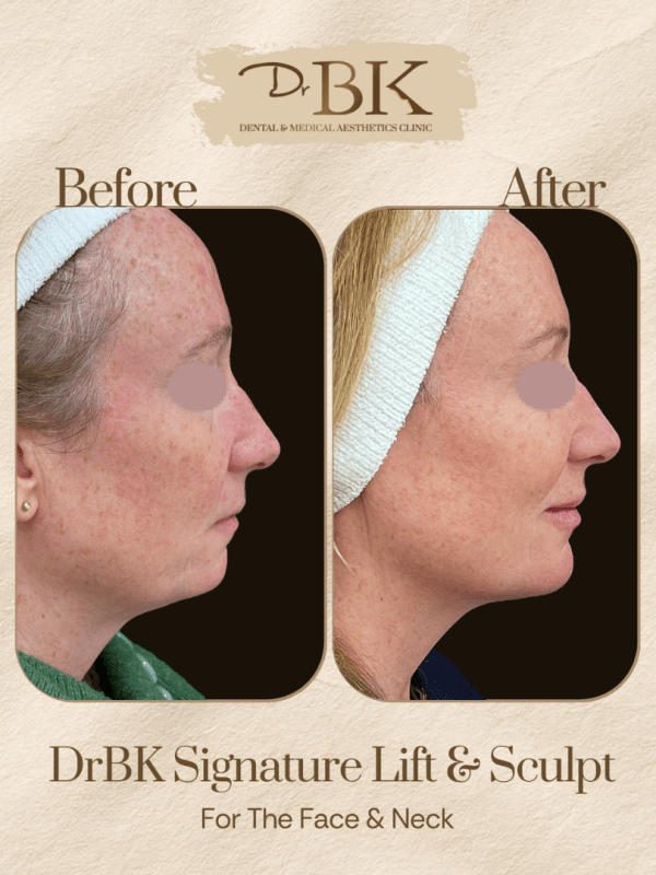 21 Before and after image of DrBK Signature Non-Surgical Facelift with Threads