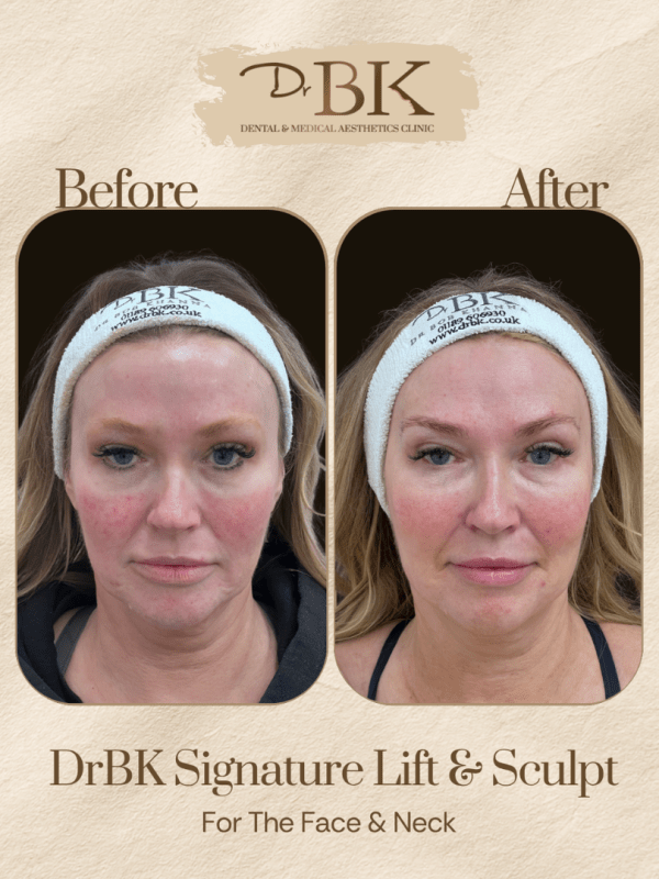 22 Before and after image of DrBK Signature Non-Surgical Facelift with Threads