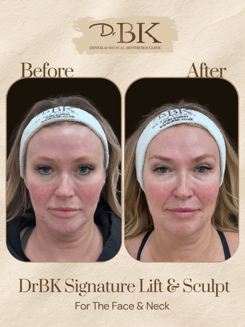22 Before and after image of DrBK Signature Non-Surgical Facelift with Threads
