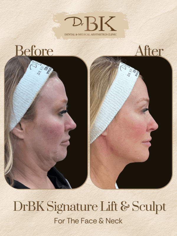 24 Before and after image of DrBK Signature Non-Surgical Facelift with Threads