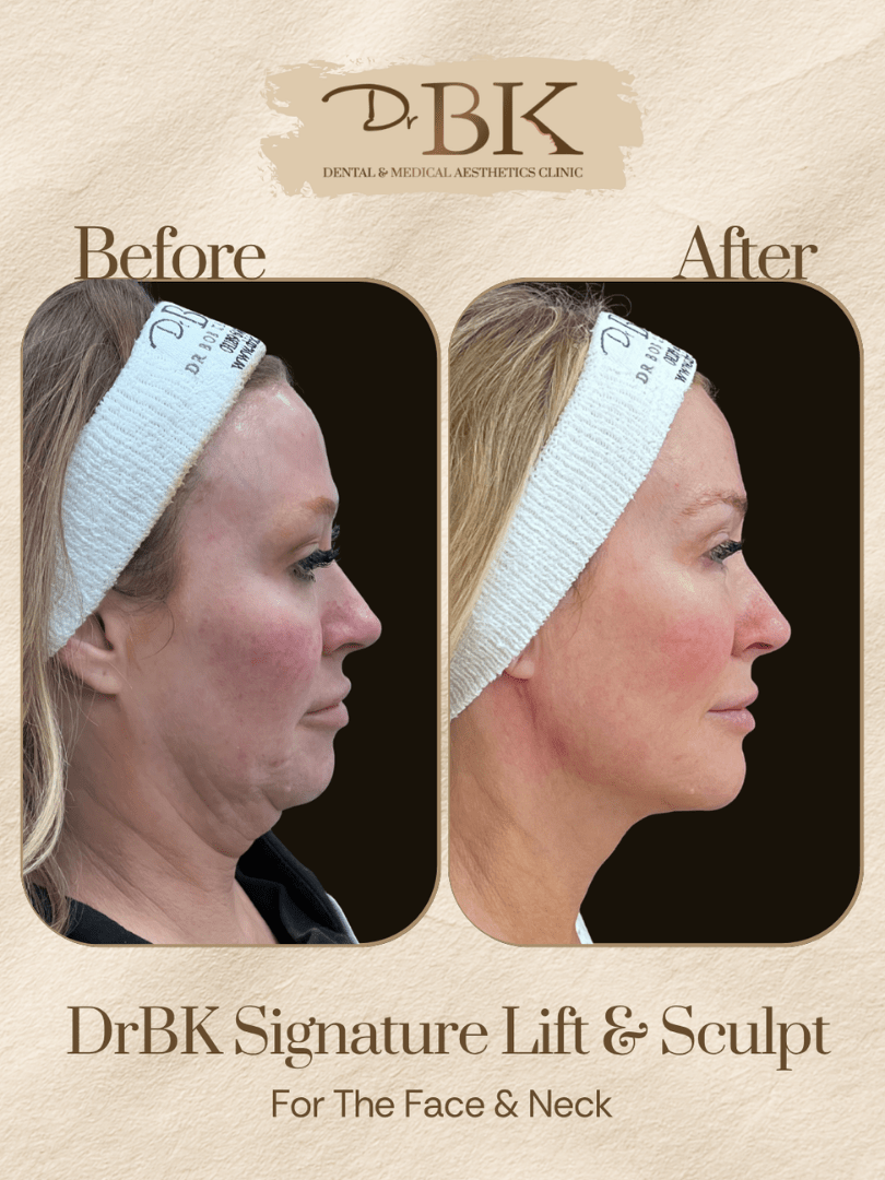 24 Before and after image of DrBK Signature Non-Surgical Facelift with Threads