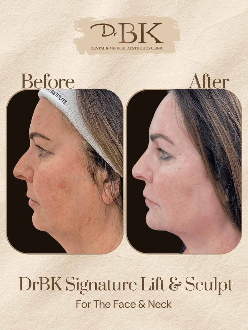 25 Before and after image of DrBK Signature Non-Surgical Facelift with Threads