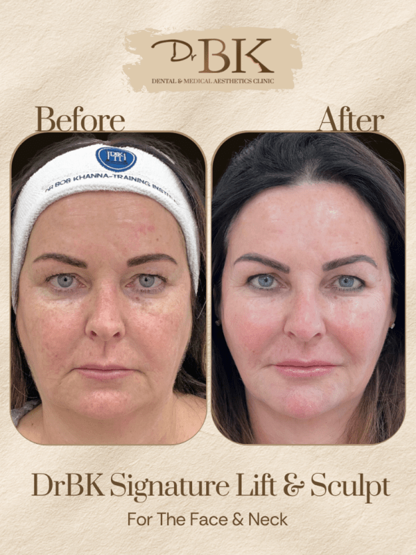 26 Before and after image of DrBK Signature Non-Surgical Facelift with Threads