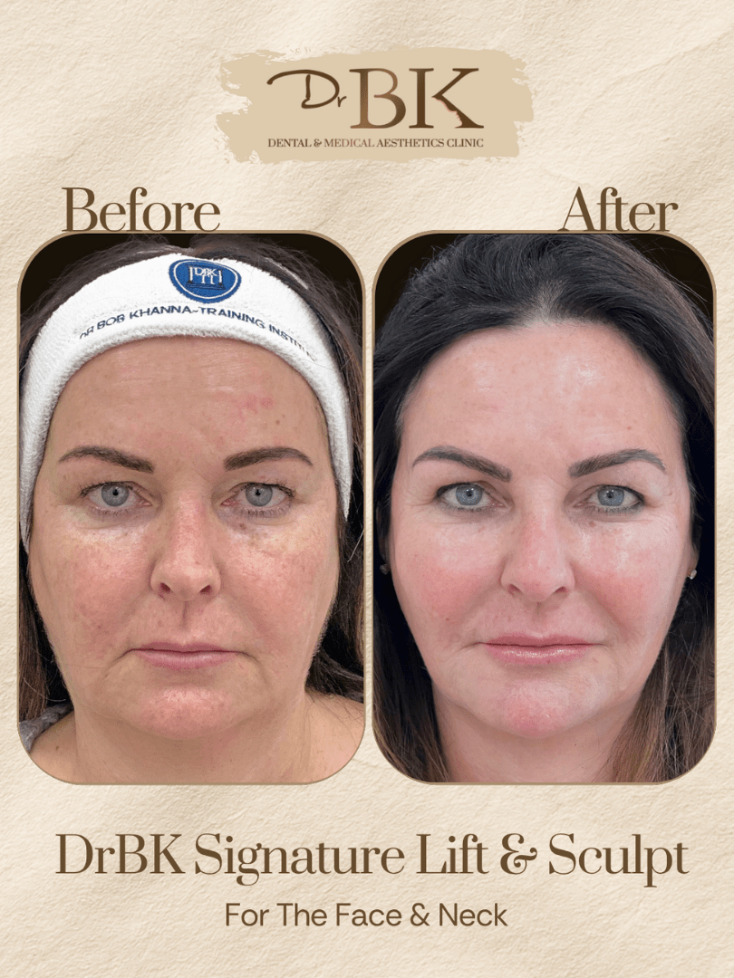 26 Before and after image of DrBK Signature Non-Surgical Facelift with Threads